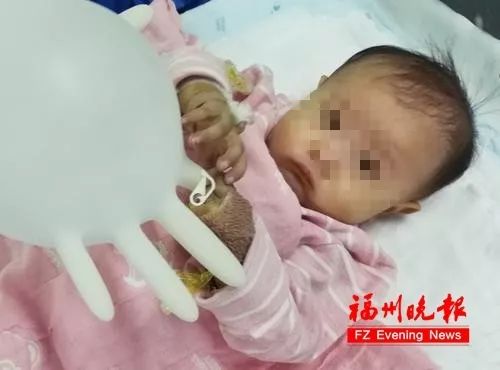 女嬰兩天哭鬧不止竟頭發(fā)絲繞腳趾