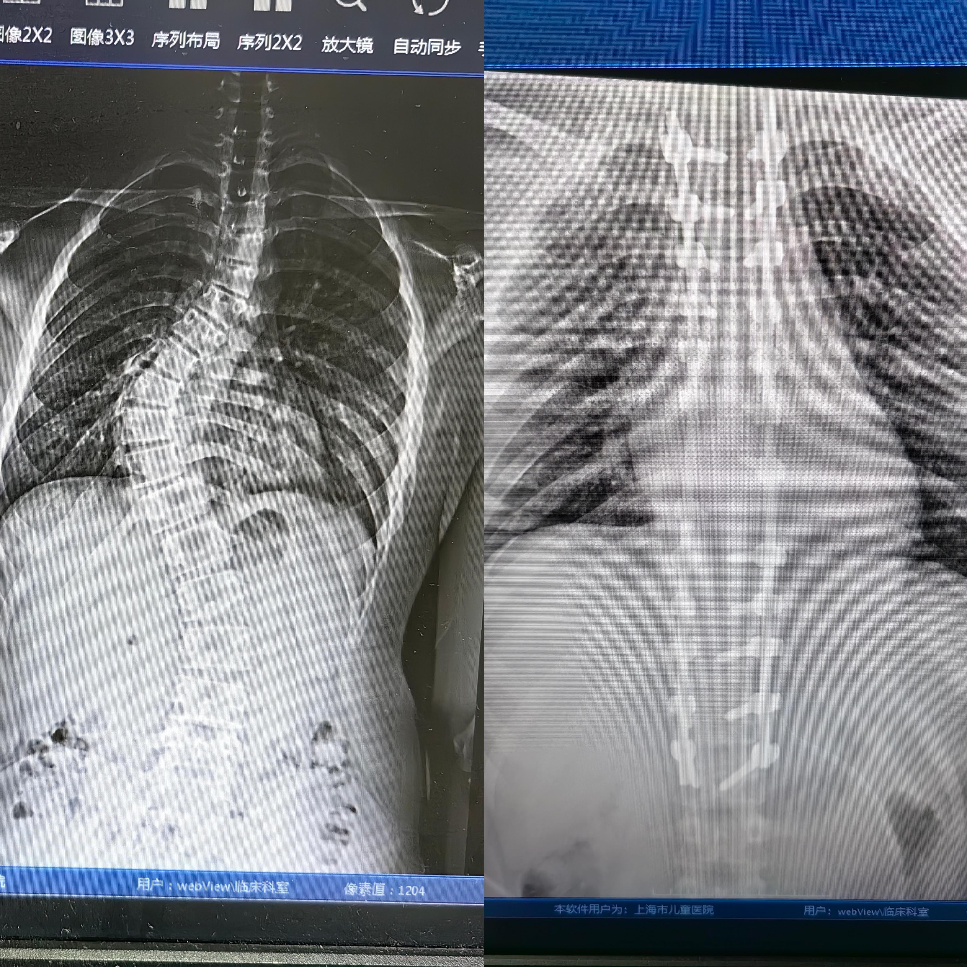 如何自測(cè)孩子是否脊柱側(cè)彎