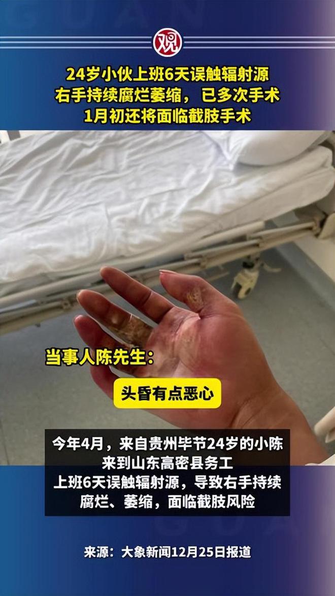 24歲小伙上班6天誤觸輻射源即將截肢