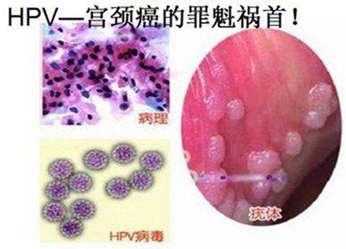 一碼一肖一特馬報,女子美甲后感染HPV病毒長出菜花